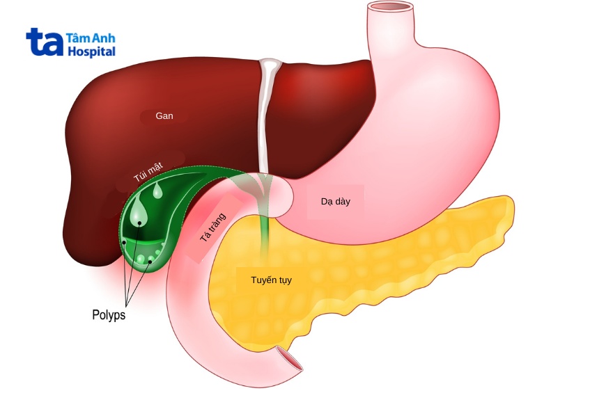 chữa đa polyp túi mật