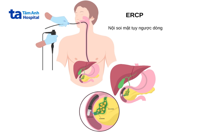 chữa sỏi ống mật chủ