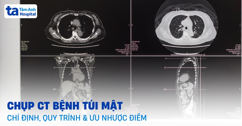 Chụp CT bệnh túi mật là gì? Chỉ định, quy trình và ưu nhược điểm
