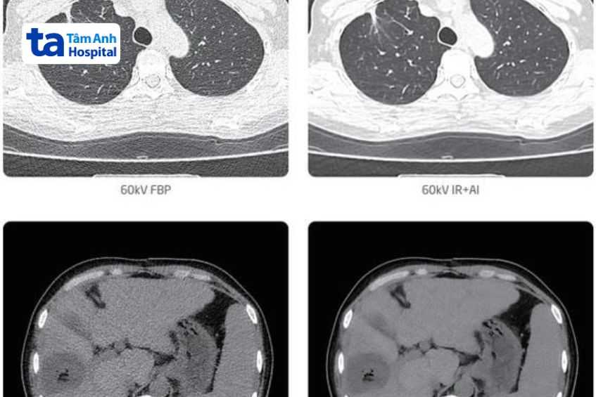 chụp ct scanner 32 dãy