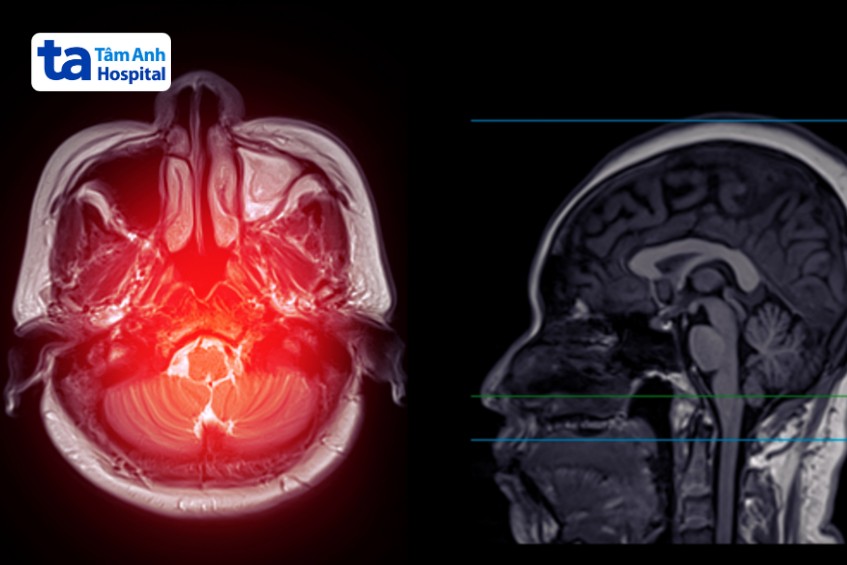 chụp mri có thuốc cản quang