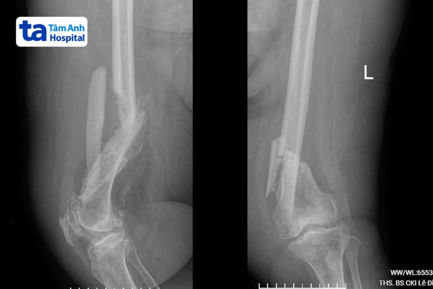 chụp x quang xương đùi bà lành