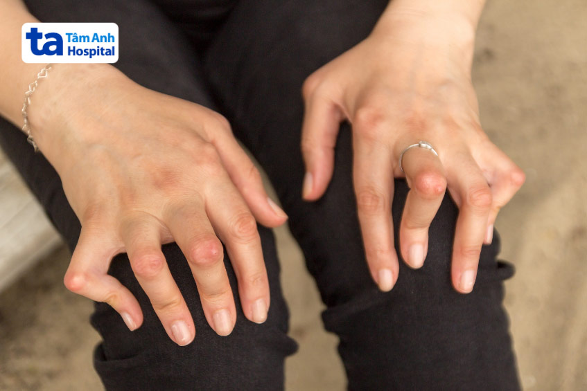 Có nhiều loại bệnh viêm khớp tự miễn