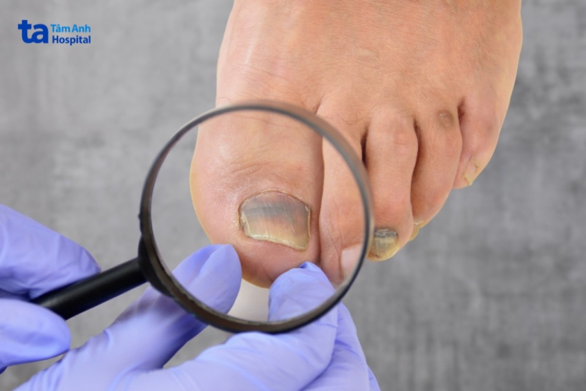 có thể lây nhiễm sang chân