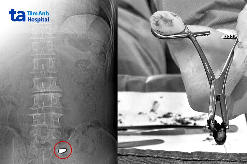 đầu đạn tồn tại suốt 40 năm trong cơ thể ông điệp