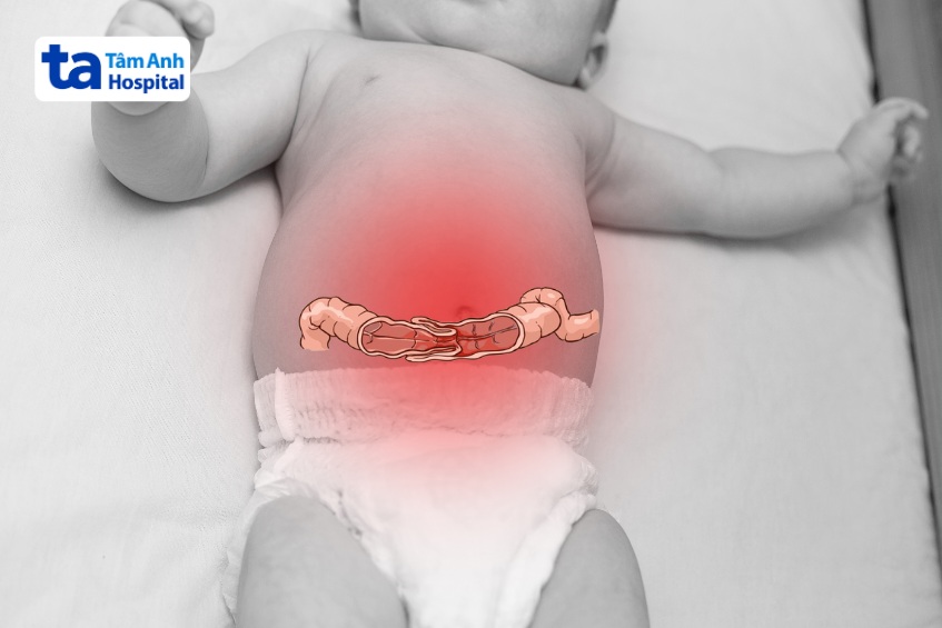 dấu hiệu ban đầu cảnh báo lồng ruột