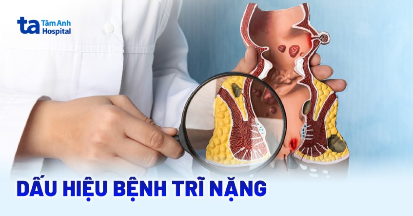 Dấu hiệu bệnh trĩ nặng: Nguyên nhân, chẩn đoán và phòng ngừa
