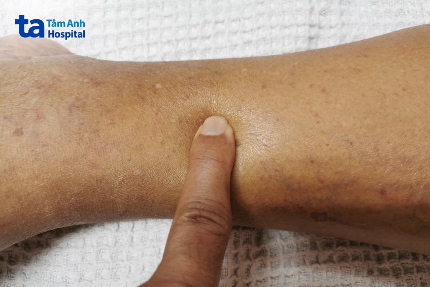 dấu hiệu hội chứng thận hư tái phát