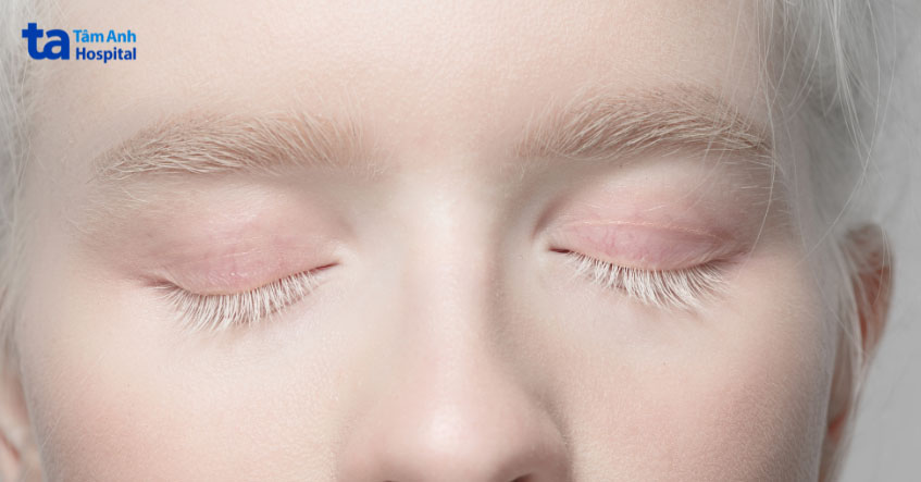 Dấu hiệu nhận biết bệnh bạch tạng