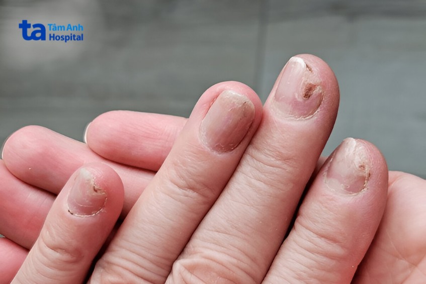 dấu hiệu nhận biết bị nấm kẽ móng tay