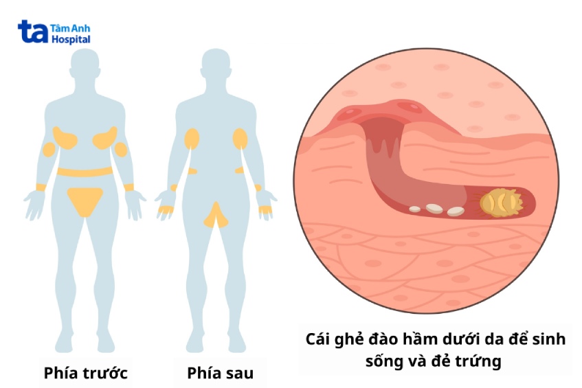 dấu hiệu nhận biết cụ thể khi bị ghẻ