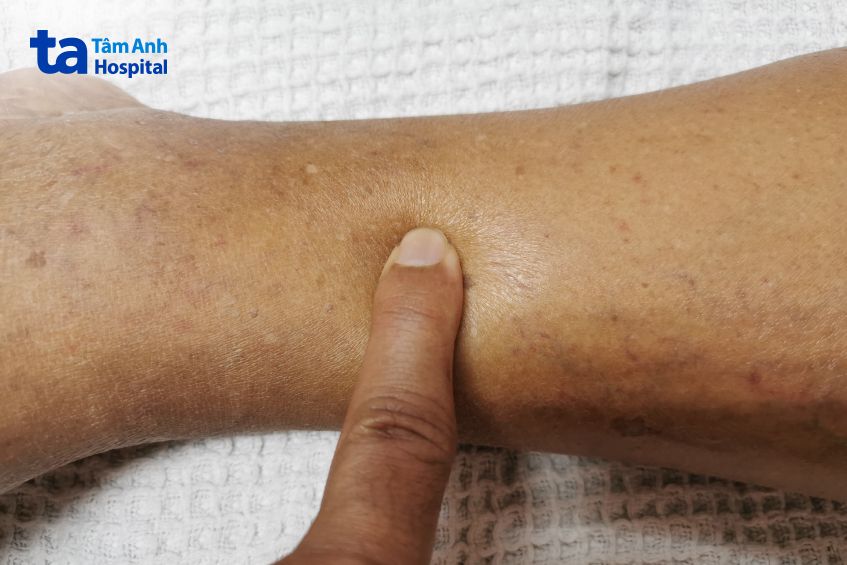 dấu hiệu phù trong hội chứng thận hư