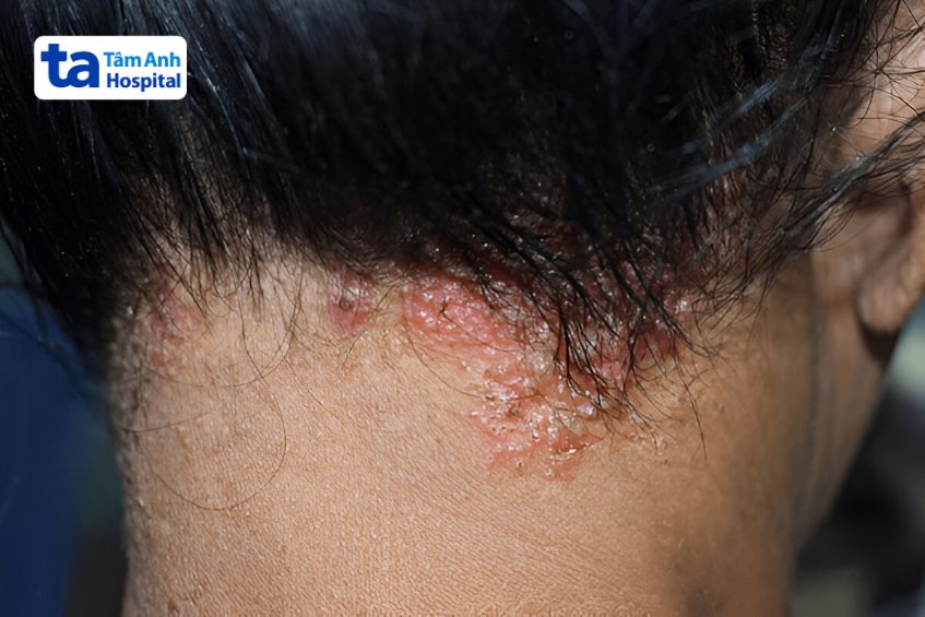 dấu hiệu trên đầu bị nổi ghẻ