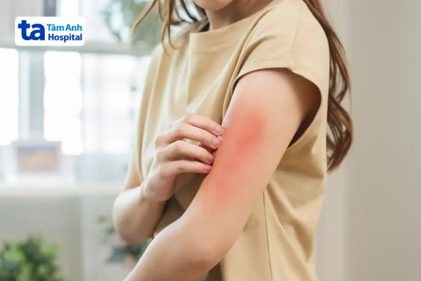 Dị ứng đạm có thể gây ra những phản ứng tiêu cực trên da