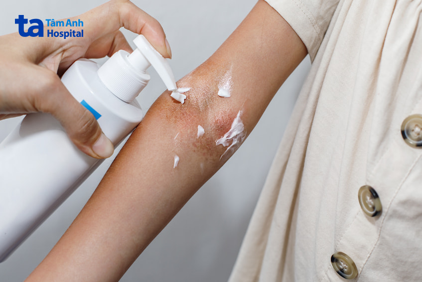 Các biện pháp hỗ trợ khác để cải thiện viêm da tiếp xúc dị ứng