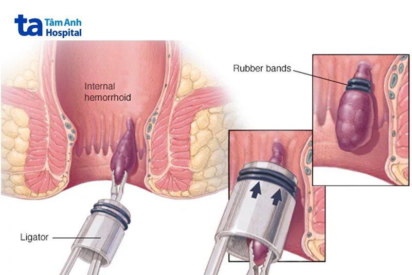 điều trị bệnh trĩ nặng