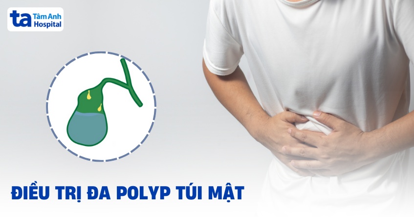 điều trị đa polyp túi mật
