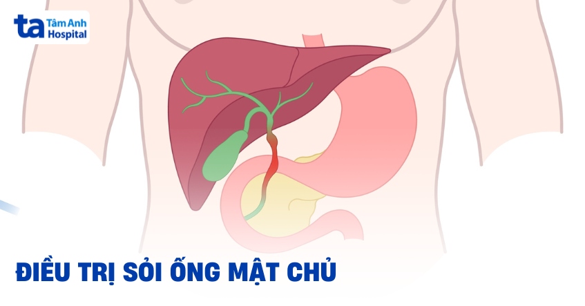 4 phương pháp điều trị sỏi ống mật chủ phổ biến hiện nay