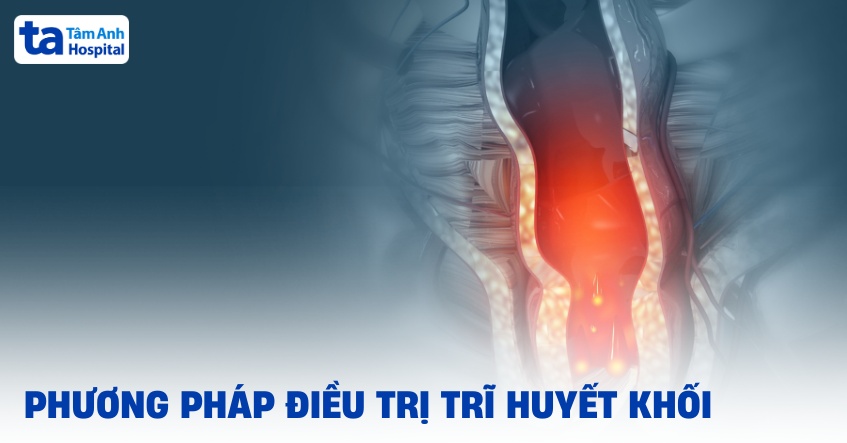 điều trị trĩ huyết khối