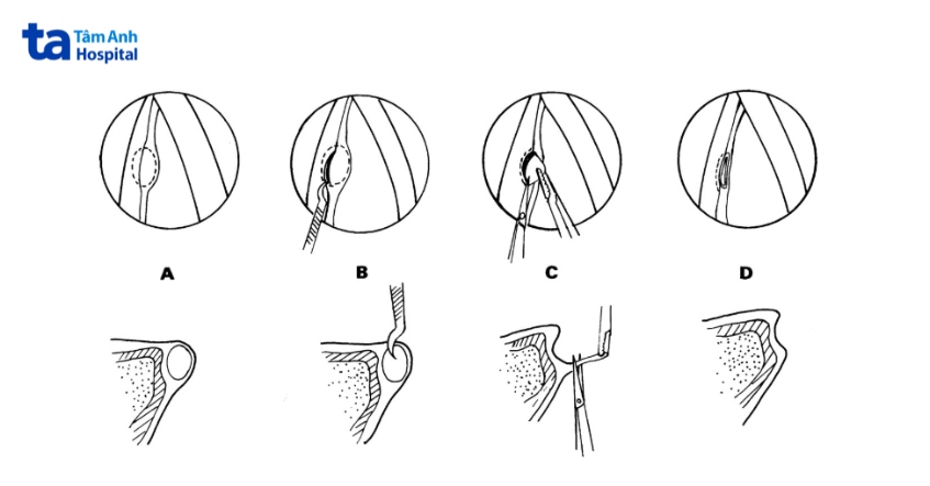 điều trị u nang dây thanh quản