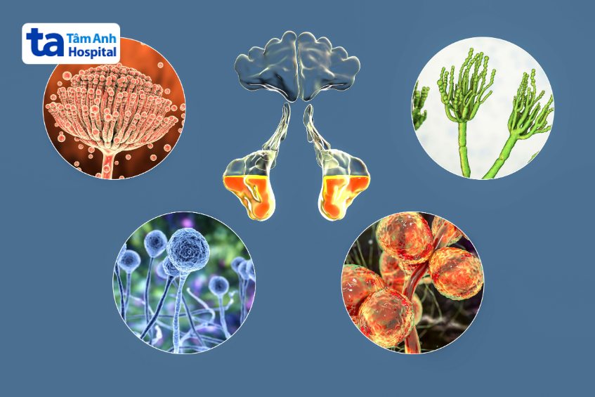 điều trị viêm xoang nấm