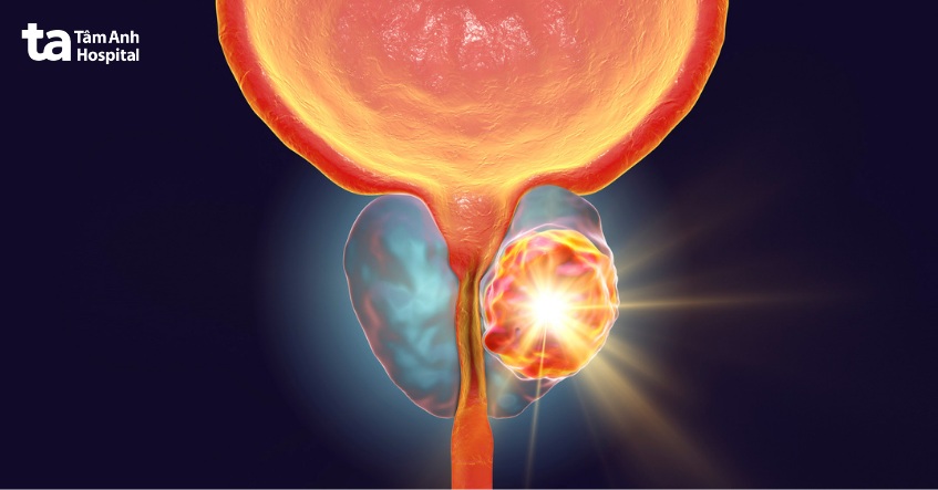 do phì đại tuyến tiền liệt chèn ép niệu quản