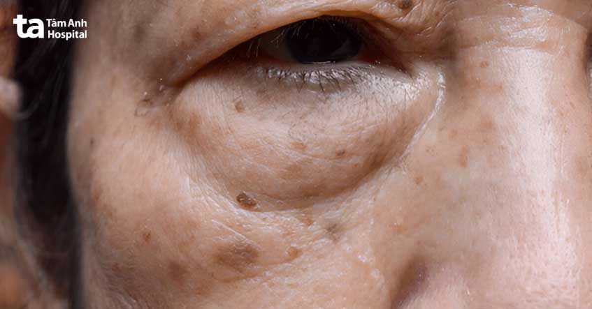 Đồi mồi có thể xuất hiện mọi vị trí trên da