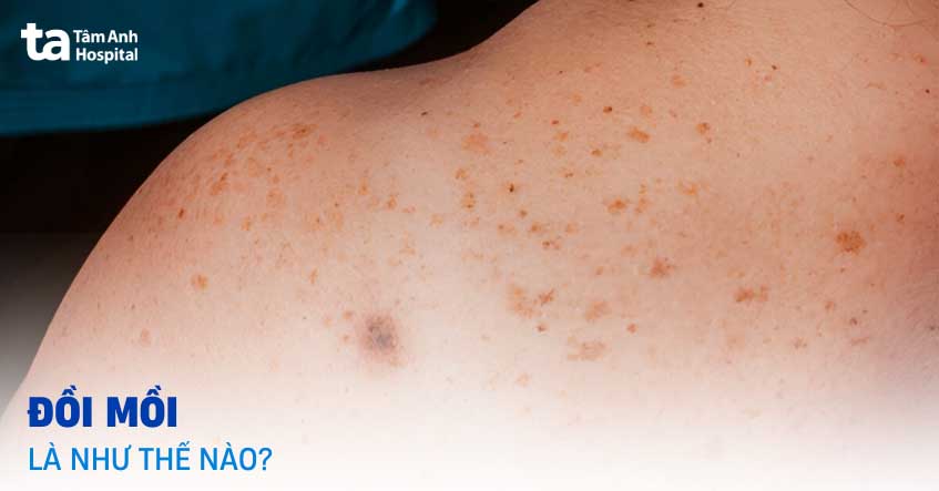 đồi mồi là gì