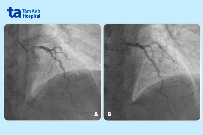 Động mạch liên thất hẹp rải rác (hình A) và sau khi được nong mạch đặt stent (hình B)