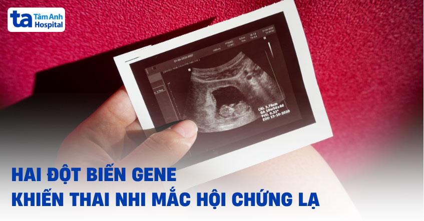 Hai đột biến gene khiến thai nhi mắc hội chứng lạ