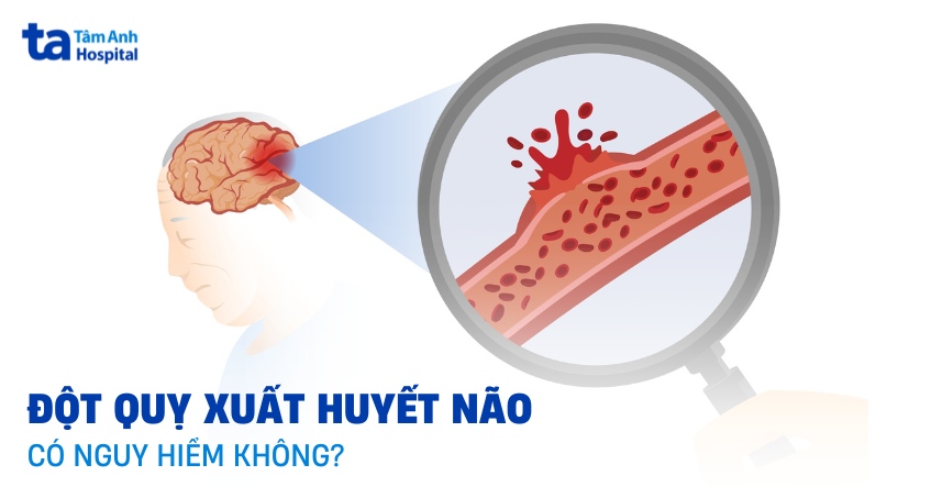 Đột quỵ xuất huyết não có nguy hiểm không? Ảnh hưởng ra sao?