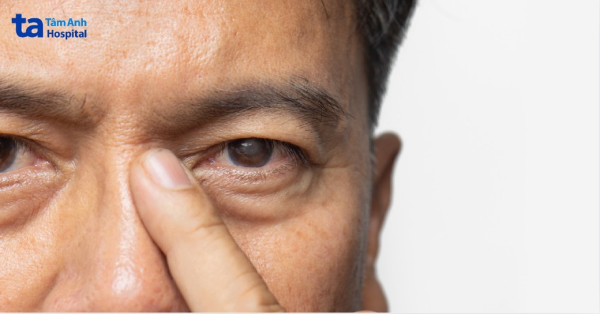 đục thủy tinh thể có thể phát triển như biến chứng của suy thận