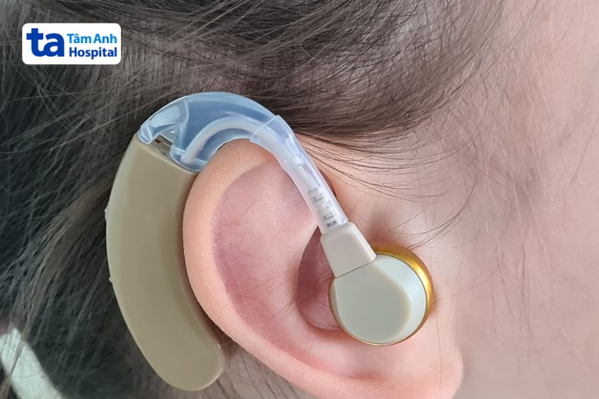 dùng máy trợ thính chữa nghe kém