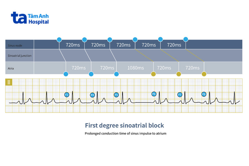 ECG không thể đánh giá chính xác block xoang nhĩ độ 1