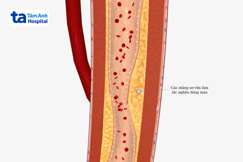 gây ra tình trạng tắc nghẽn mạch máu