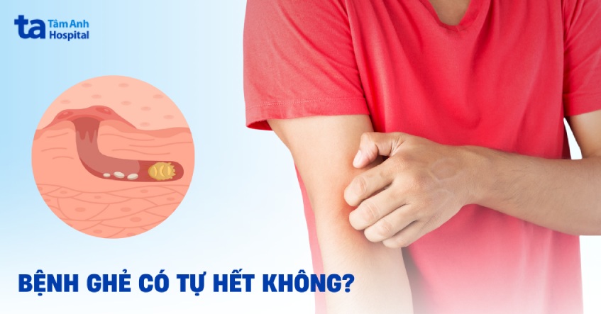 Ghẻ có tự hết không? Yếu tố nào ảnh hưởng khả năng tự khỏi?