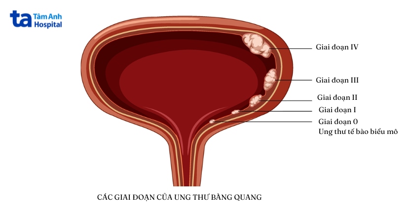 giai đoạn phát triển ung thư bàng quang