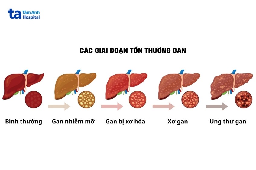 giai đoạn tổn thương gan