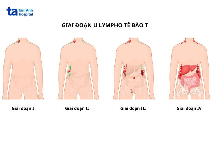 giai-đoạn-u-lympho-tế-bào-t