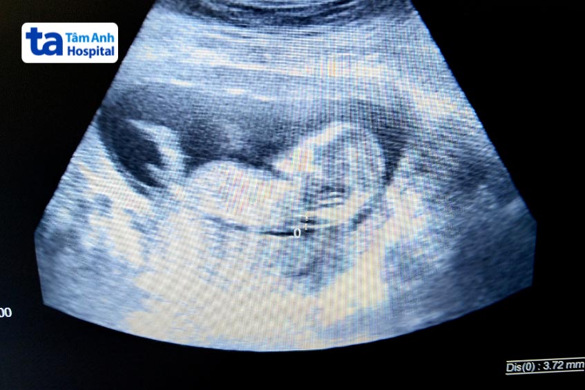 giúp phát hiện bất thường của thai nhi