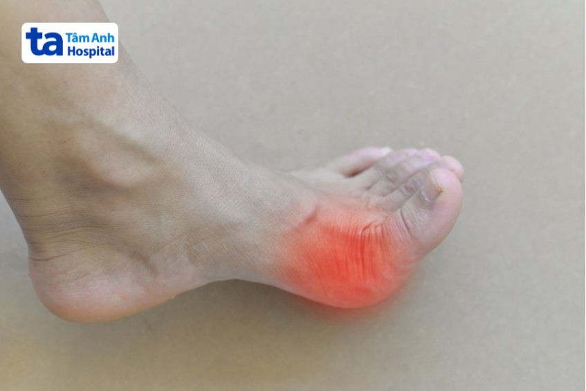 gout ảnh hưởng cơ thể gây giảm sinh lý