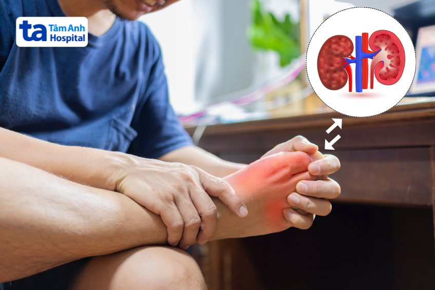 gout và thận liên quan gì nhau