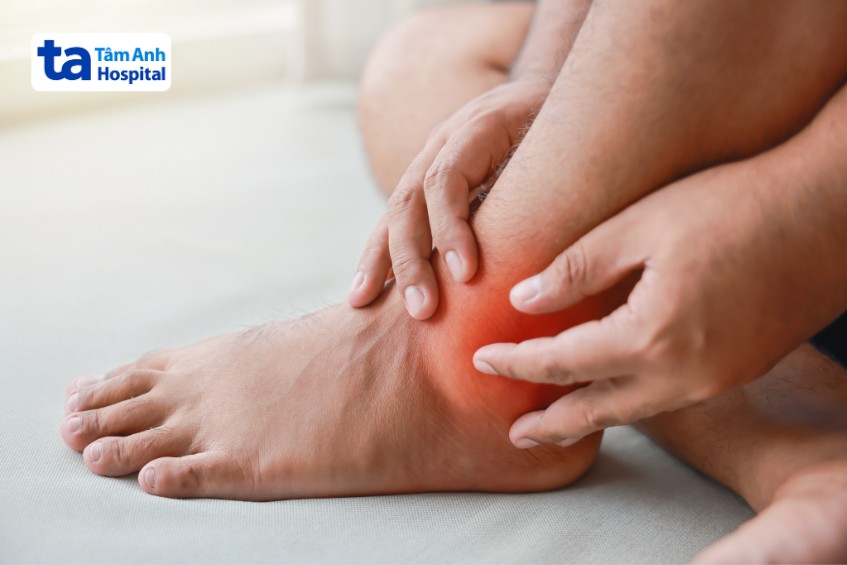 gút vô căn là viêm khớp tích tụ