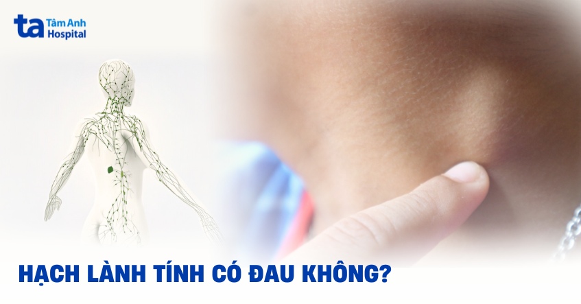 Hạch lành tính có đau không? Dấu hiệu nổi hạch cần lưu ý