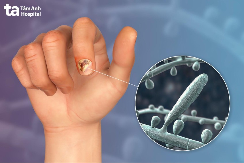 hạn chế sơn móng tay và làm móng giả