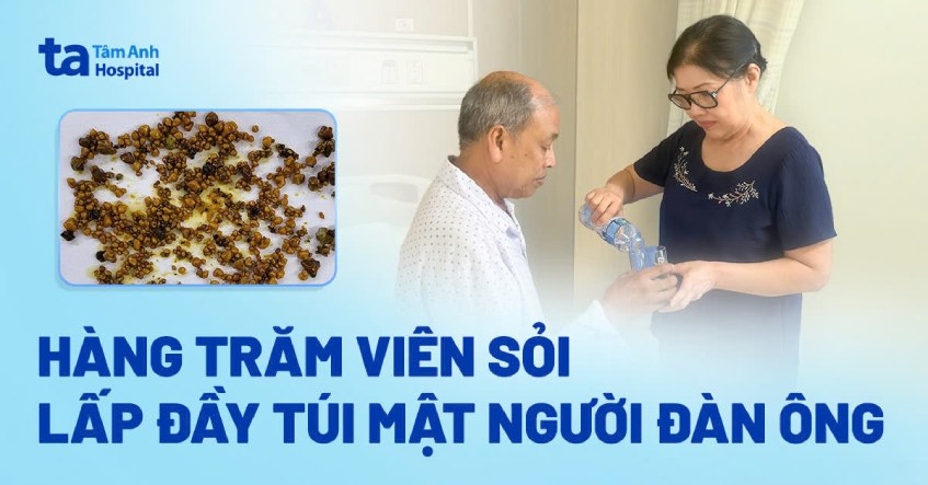 hàng trăm viên sỏi mật