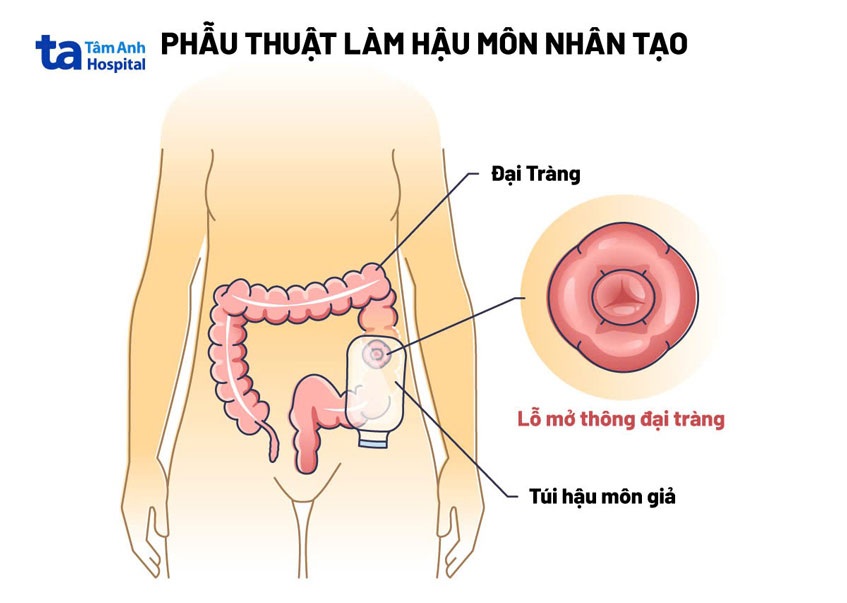 hậu môn nhân tạo ở trẻ