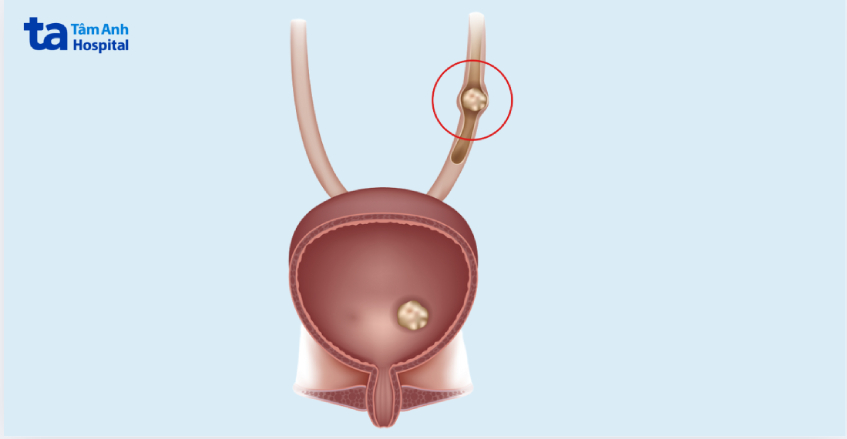 hiểu thêm về tình trạng sỏi niệu quản 1 3 dưới 6mm