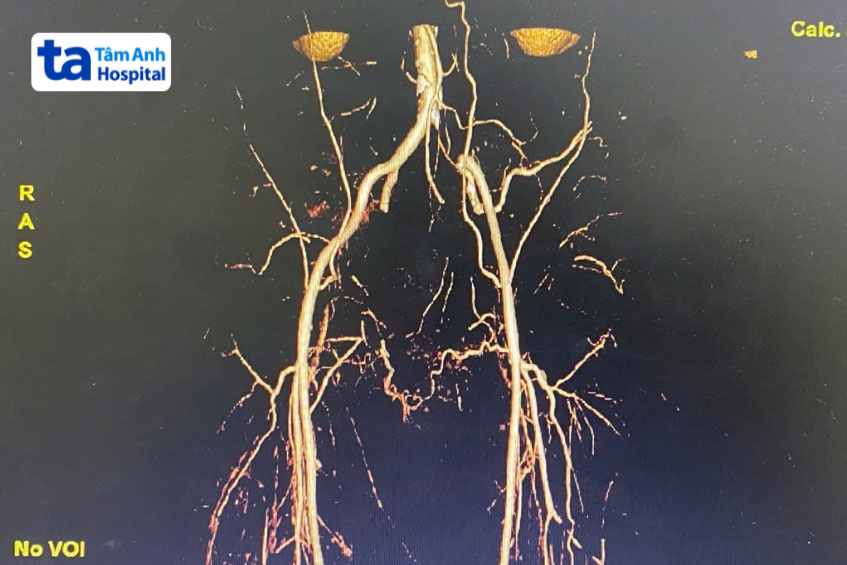 Hình ảnh bệnh nhân được mổ tắc mạch