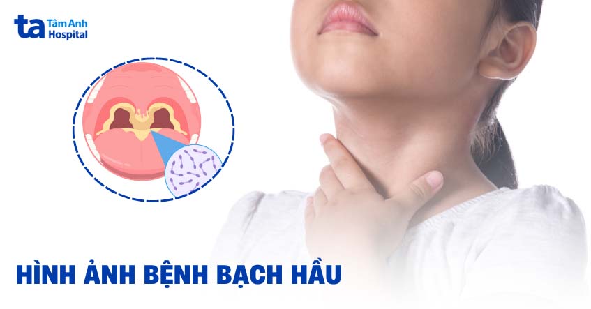 Các hình ảnh bị bạch hầu trên thực tế